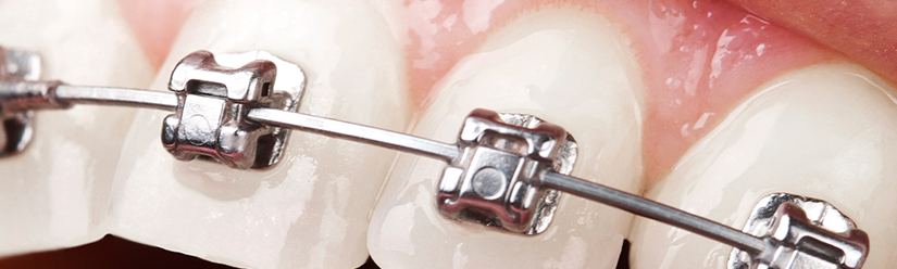 brackets metálicos - Clínica dental Denia Doctoras Gandía