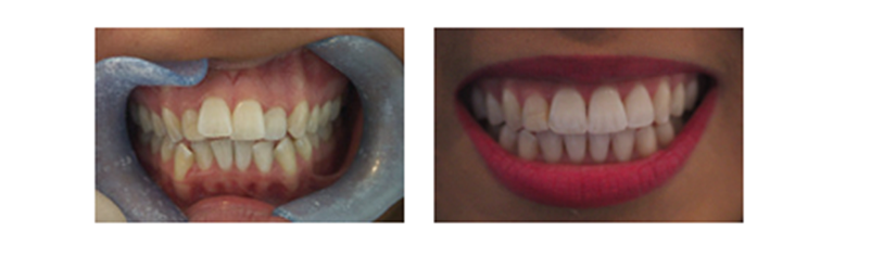 ortodoncia invisible - ortodoncia Invisalign - Clínica dental Denia Doctoras Gandía