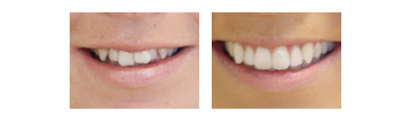 ortodoncia invisible - ortodoncia Invisalign - Clínica dental Denia Doctoras Gandía