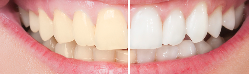 carillas dentales - carillas de composite - Clínica dental Denia Doctoras Gandía
