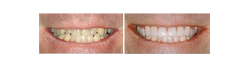 carillas Lumineers ® sin tallado - carillas dentales estéticas - Clínica dental Denia Doctoras Gandía