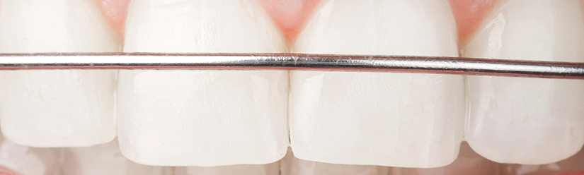 retenedores dentales - Clínica dental Denia Doctoras Gandía retenedores dentales - Clínica dental Denia Doctoras Gandía