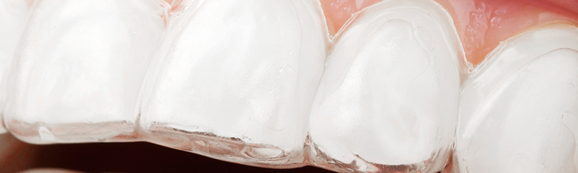 retenedores dentales - Clínica dental Denia Doctoras Gandía retenedores dentales - Clínica dental Denia Doctoras Gandía