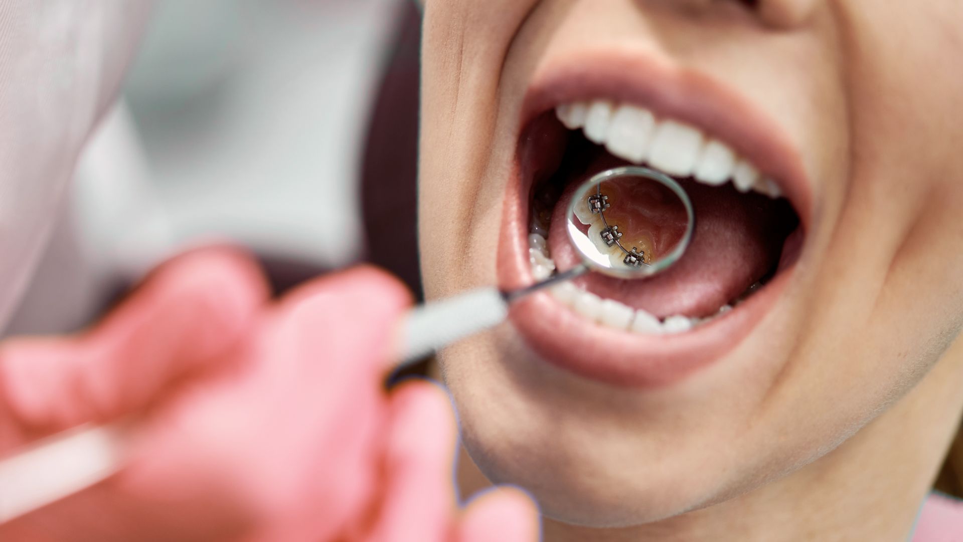 Invisalign Teen | Clínica Dental Dras. Gandía Ortodoncia lingual clinica doctoras gandia