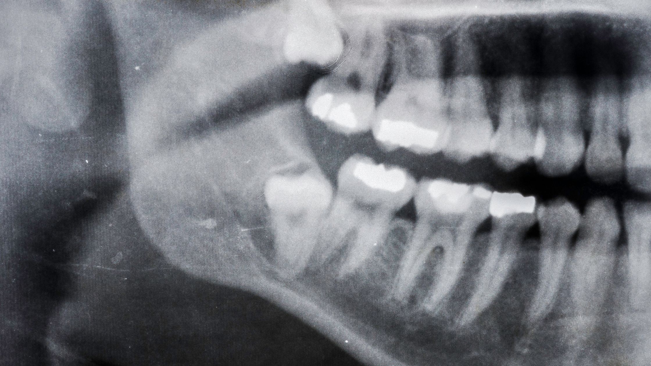 Diente impactado: diagnóstico y tratamiento
