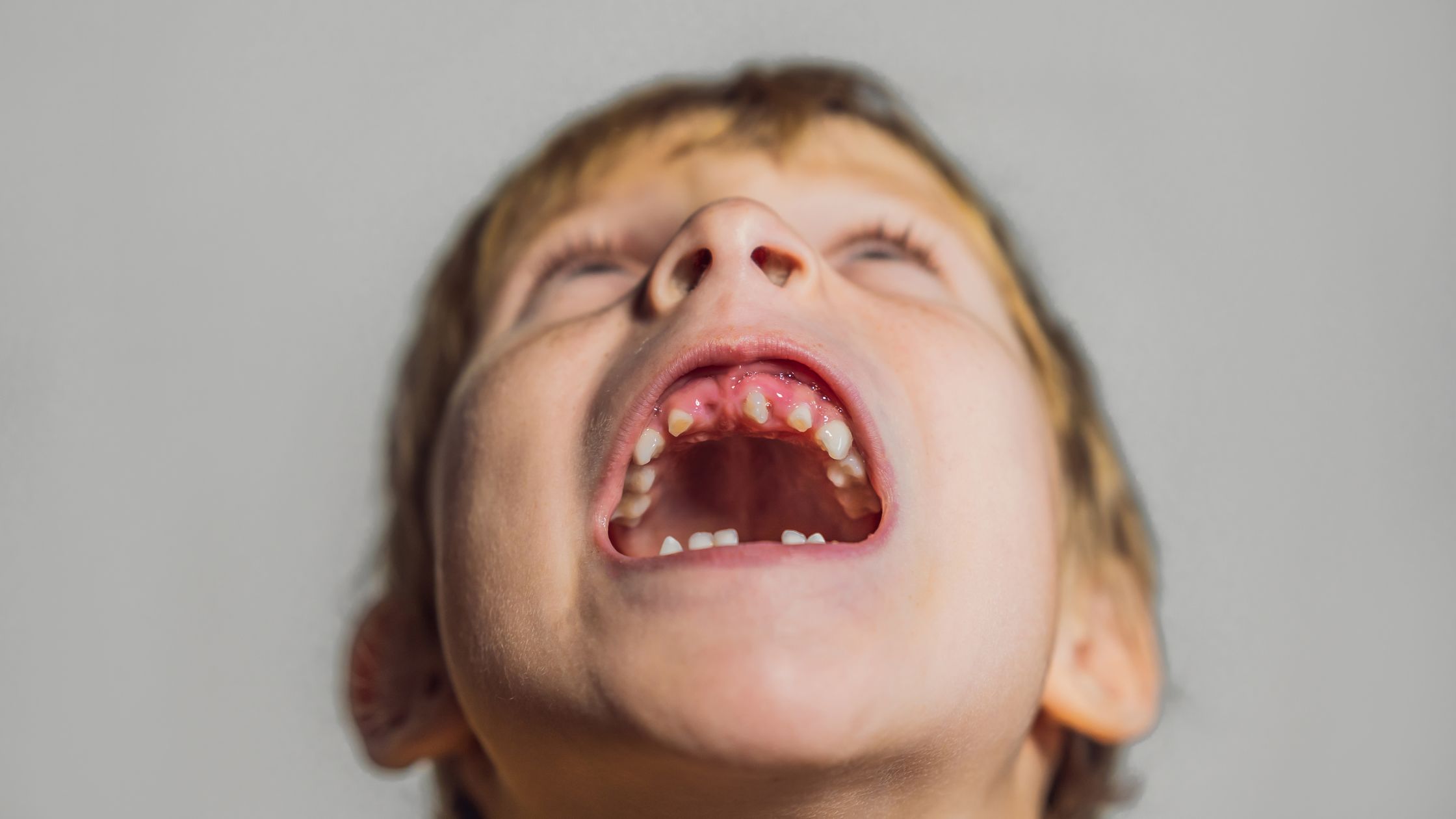 Frenillo corto: síntomas y tratamientos